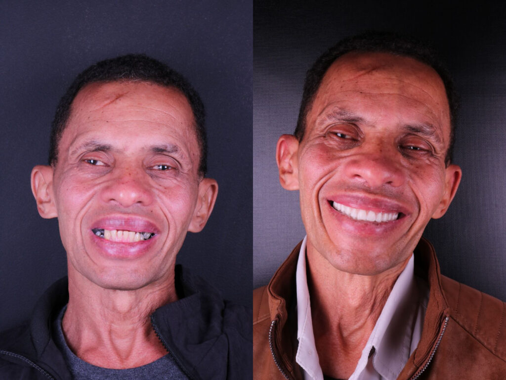 Prótese Implante Dentário