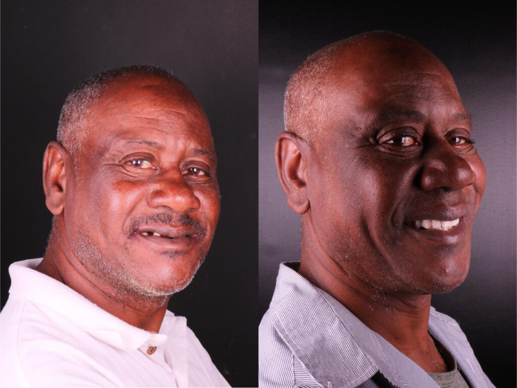 Prótese Implante Dentário